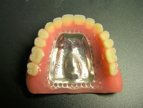 写真 チタン床義歯（総入れ歯/部分入れ歯）