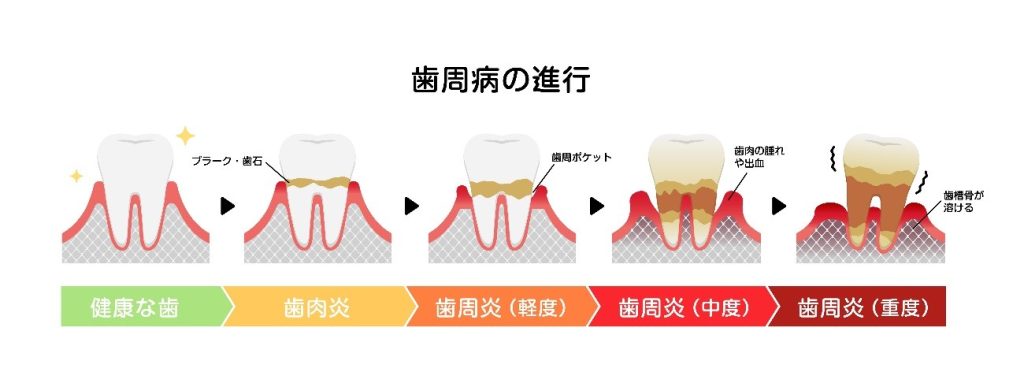 仙台市青葉区一番町にある歯科医院、仙台一番町やながわ歯科医院では歯周病の進行度合いに応じた適切な治療で、お口を健やかな状態へと導きます。